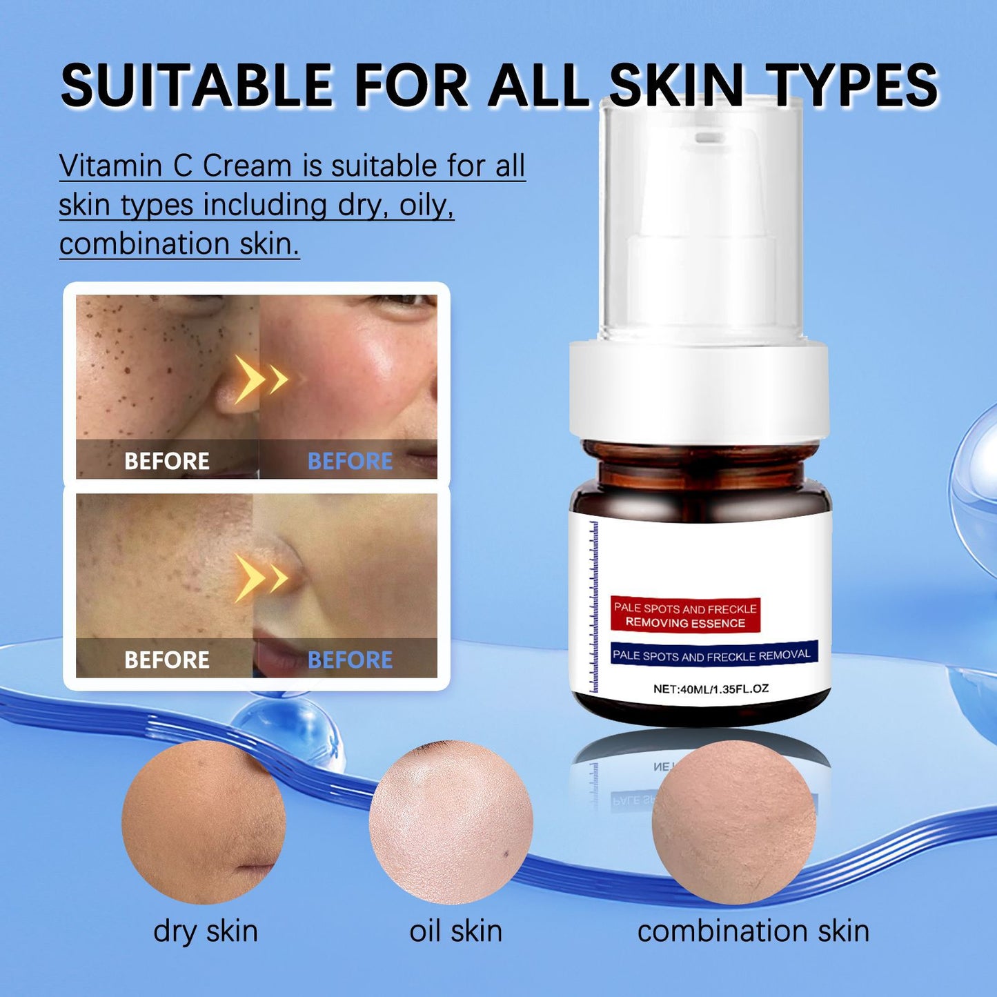 🔥3-day freckle removal: Freckles Disappear, Pigmentation Dissipates, and Skin looks brand New! ✨Vitamin C Freckle Removal Essence➡️