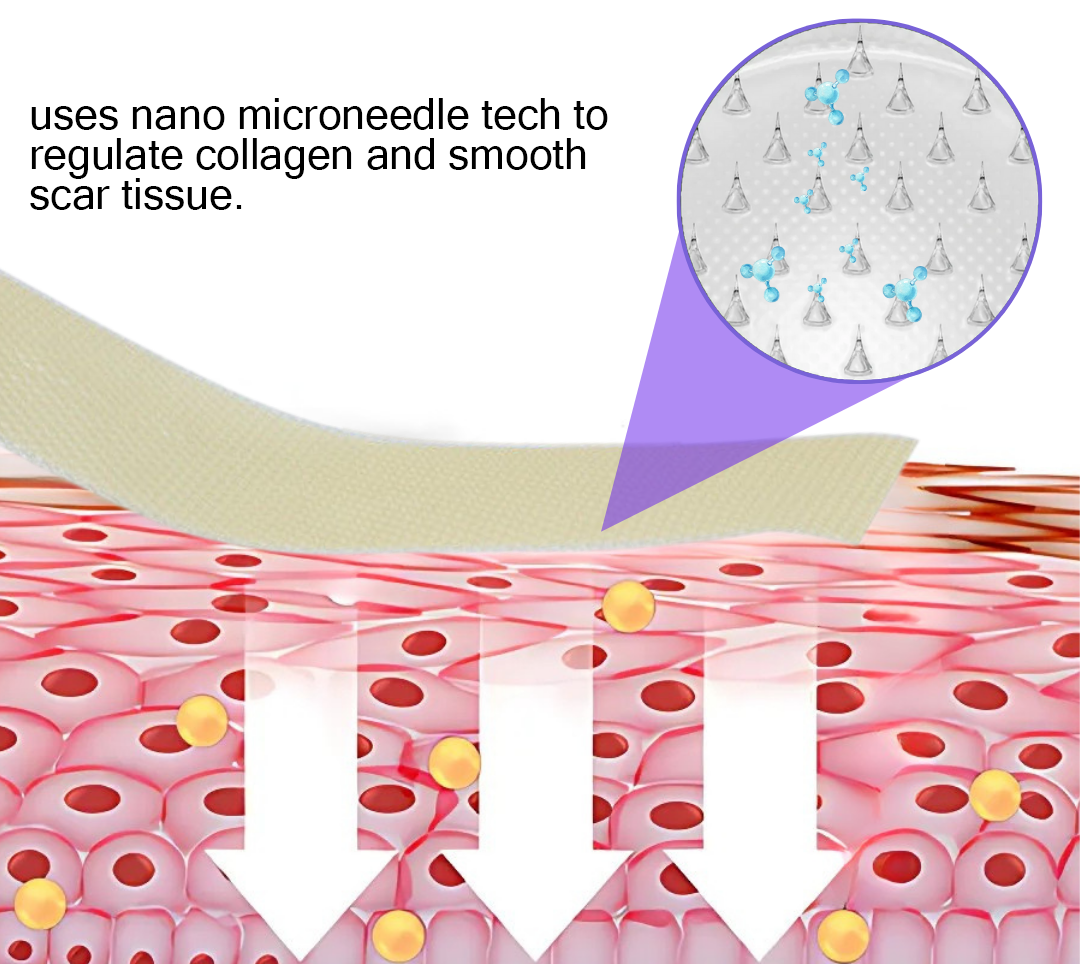 Offizieller Shop: ReGen Microneedles Pro Patches mit Hyaluronsäure-Nano-Heal-Behandlung für neue und alte Narben, Reduzierung von Operationsnarben, Dehnungsstreifen, Keloiden, Akne, Verbrennungen, Warzen, Dermatomen und Krampfadern