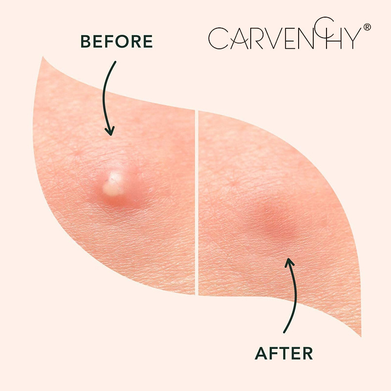 Magic Patch Invisible Acne Cover | Eliminate Acne & Perfect Skin