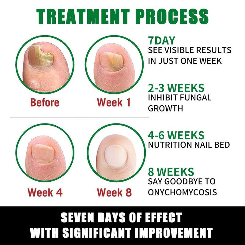 Nail Care Serum Treats fungus, for nail care, exclusive offers, supports recovery from onychomycosis and paronychia
