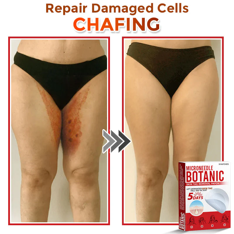 MicroNeedle Botanic Skin Tag Removal Patch