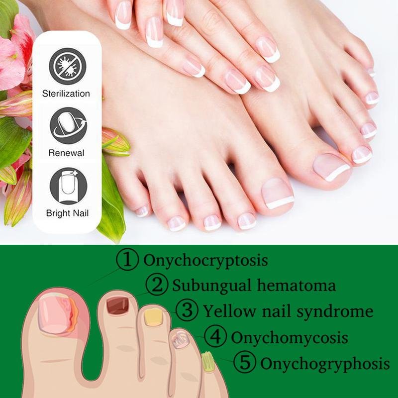Nail Care Serum Treats fungus, for nail care, exclusive offers, supports recovery from onychomycosis and paronychia