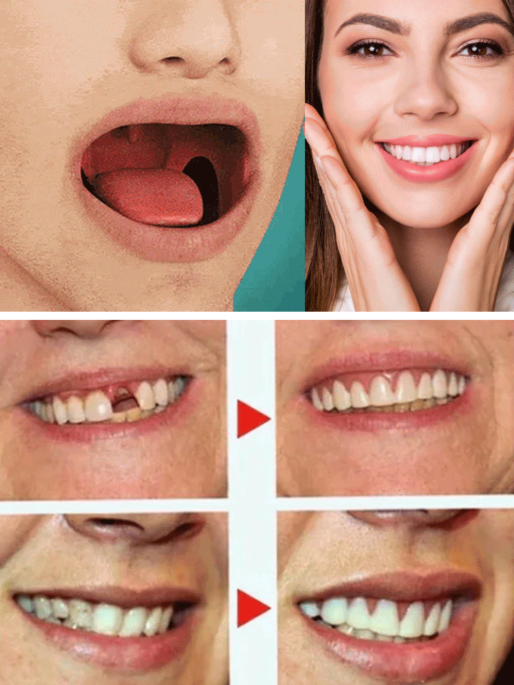 Smart Fit Silicone Retainer – No Molding Needed