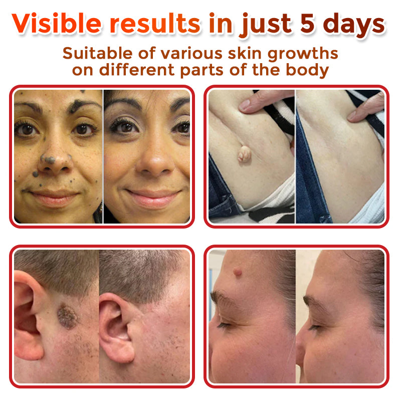 MicroNeedle Botanic Skin Tag Removal Patch