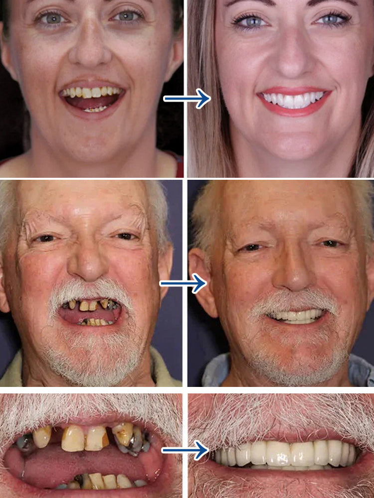 Smart Fit Silicone Retainer – No Molding Needed