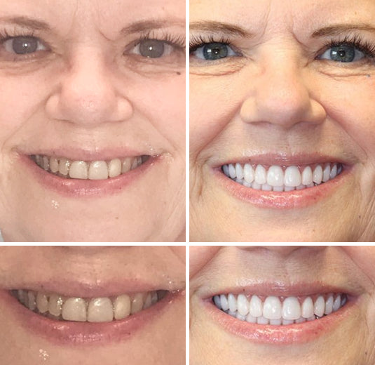 EETTSY™ - Premium Denture