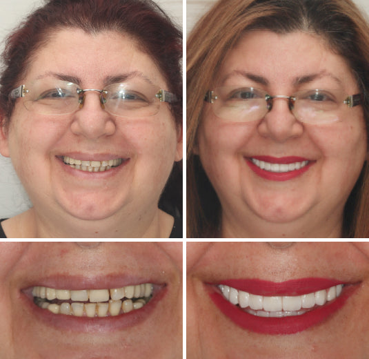 EETTSY™ - Premium Denture