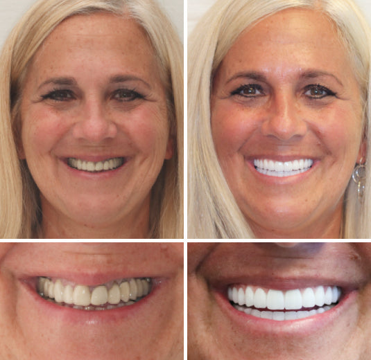 EETTSY™ - Premium Denture