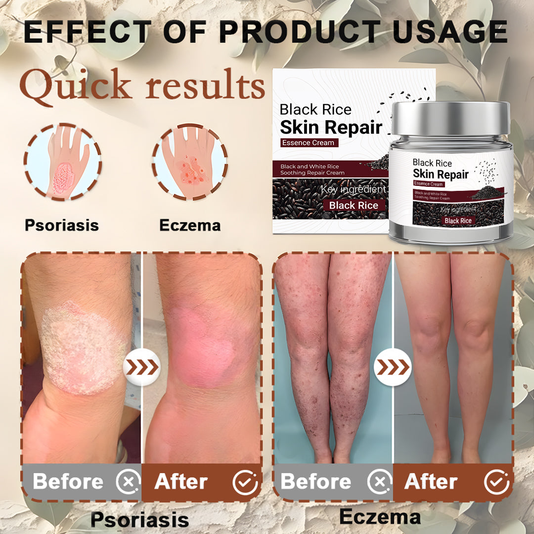 Black Rice Skin Repair Cream ⚕️ FDA Certified – Targets Warts, Psoriasis & Pigmentation