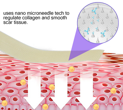 Offizieller Shop: ReGen Microneedles Pro Patches mit Hyaluronsäure-Nano-Heal-Behandlung für neue und alte Narben, Reduzierung von Operationsnarben, Dehnungsstreifen, Keloiden, Akne, Verbrennungen, Warzen, Dermatomen und Krampfadern