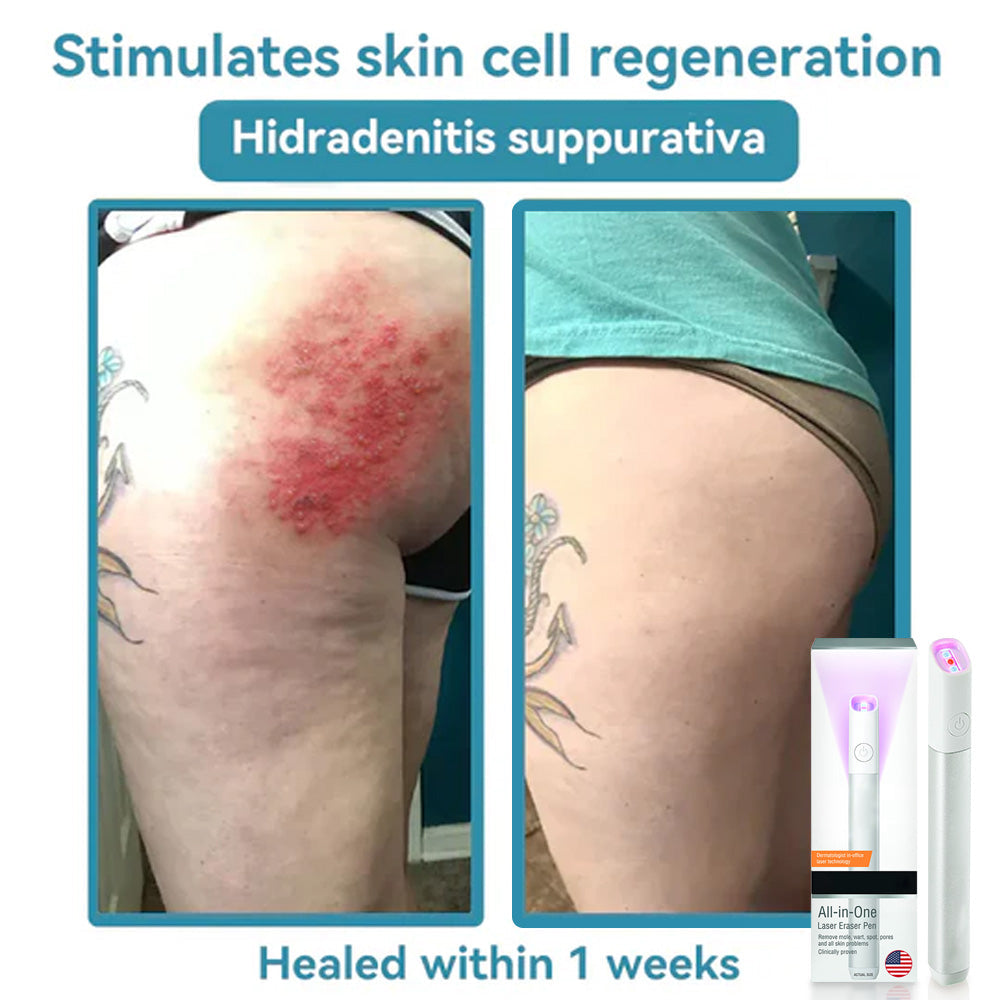 ✨All-in-One CO₂ Laser Eraser Pen | Removes Moles, Warts, Skin Flaws & Pigmentation