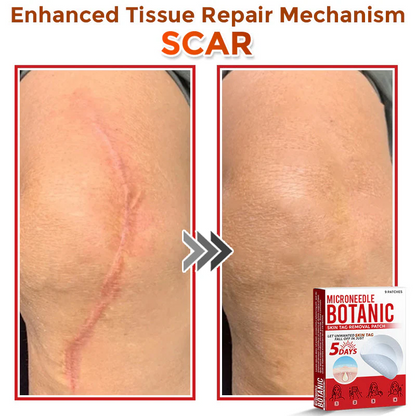MicroNeedle Botanic Skin Tag Removal Patch
