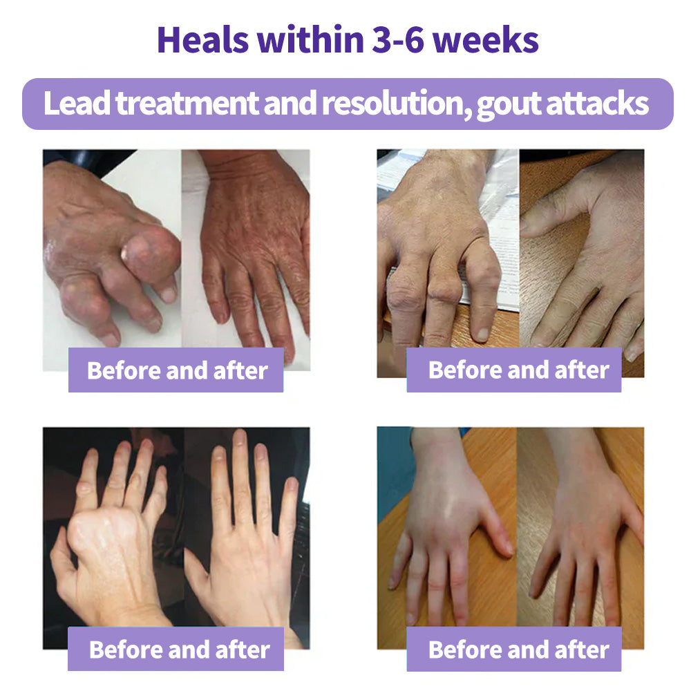 Eettsy™ Kurkuma &amp; Emu-Öl Arthritis Beruhigendes Schmerzlinderungs-Massagegel 👨‍⚕️Zugelassen von der Australian Osteopathic Association (AOA)