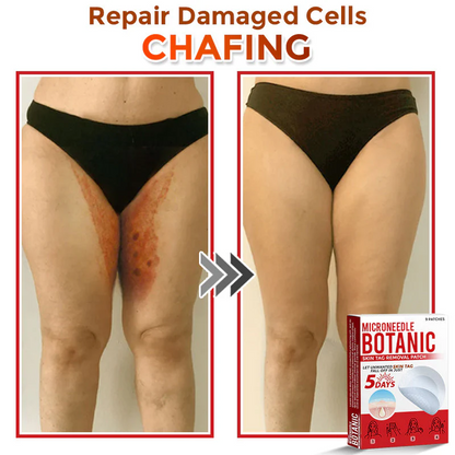 MicroNeedle Botanic Skin Tag Removal Patch
