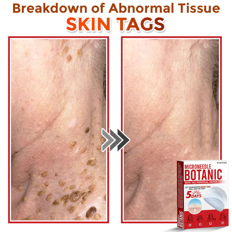 MicroNeedle Botanic Skin Tag Removal Patch