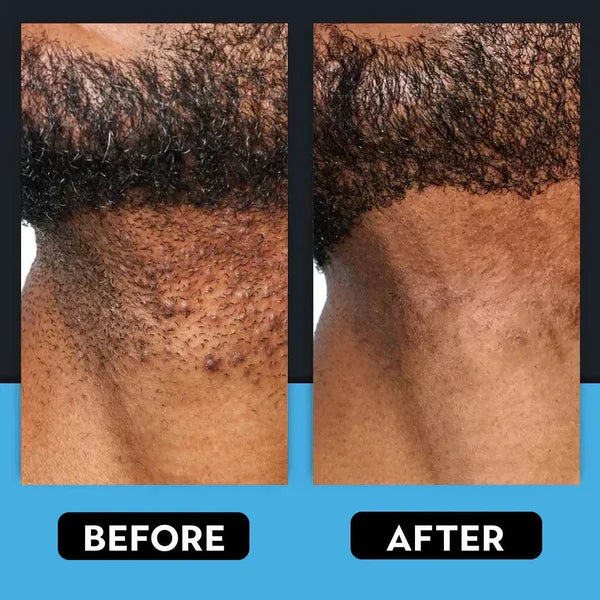 🎁Letzter Tag 80 % RABATT🎁Behandlung gegen Rasierpickel und eingewachsene Haare