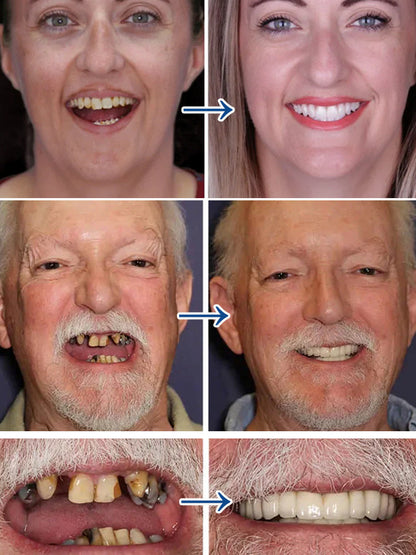 Smart Fit Silicone Retainer – No Molding Needed