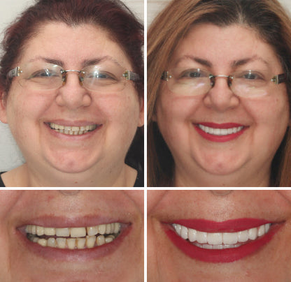 EETTSY™ - Premium Denture