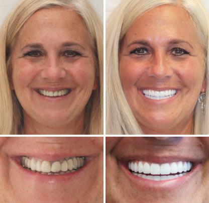 EETTSY™ - Premium Denture